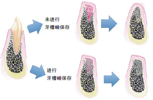 口腔种植中的牙槽嵴保存技术