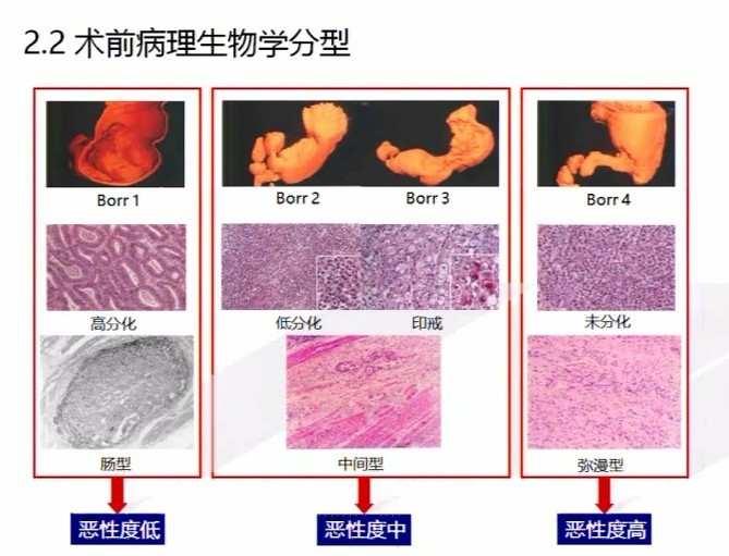 徐惠绵教授:可切除胃癌新辅助化疗疗效和手术