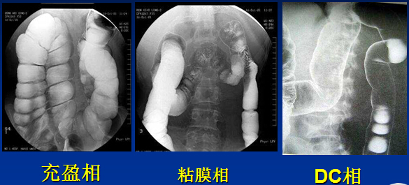 【图文并茂】 胃肠道影像检查精彩荟萃