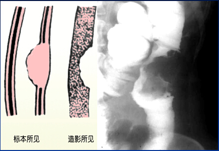 【图文并茂】 胃肠道影像检查精彩荟萃