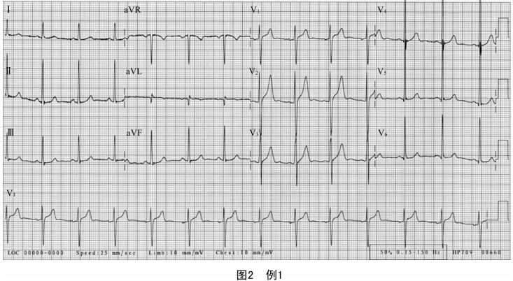 图解:影响QRS波电压的因素与左室肥厚诊断解