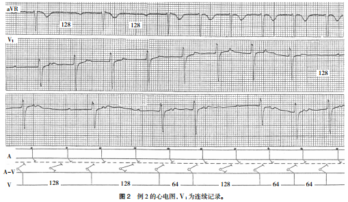 异位心律二度Ⅱ型传导阻滞(典型图例)