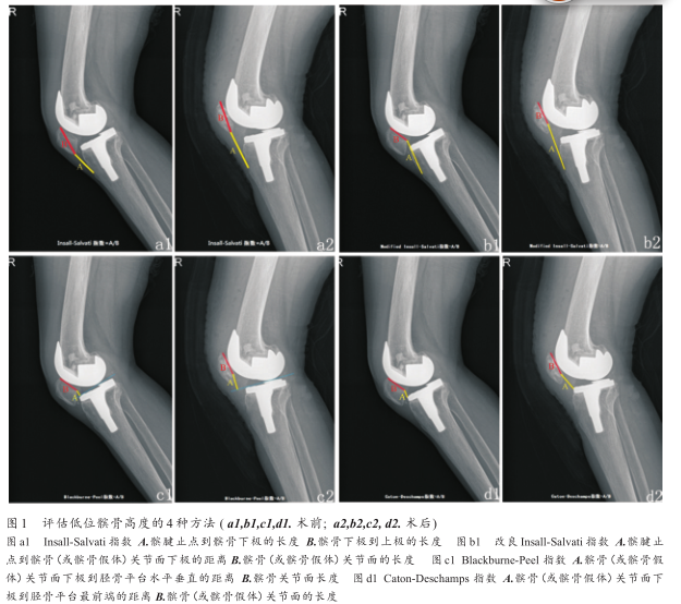 全膝关节置换术术后髌骨轨迹异常影响-因素研究进展