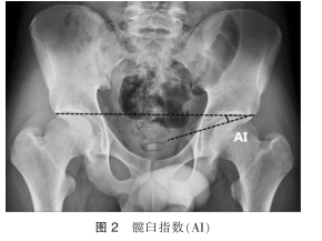 69 髋关节形态学研究及其临床意义      髋臼指数,也称髋臼角(sha