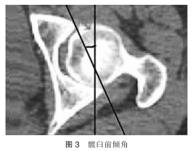 髋关节形态学研究及其临床意义_髋关节_髋臼