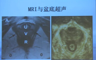 盆底超声在妇科中的应用_盆底超声_妇科诊断