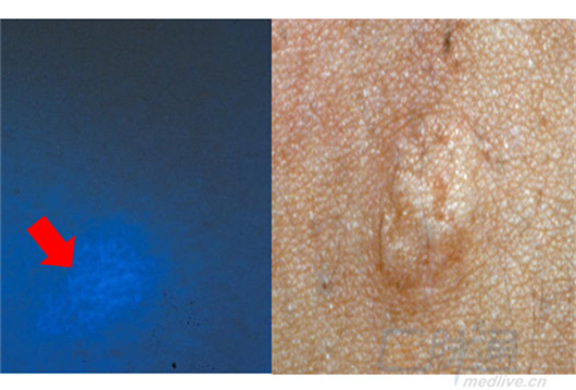 tsc所见的典型皮损是灰叶斑(fitzpatrick斑),纸屑样皮损,面部血管纤维