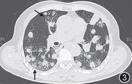 【答案公布】双肺多发结节及肿块影