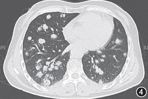【答案公布】双肺多发结节及肿块影