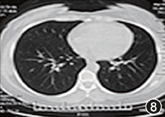 经典病例_【答案公布】发热、肺部阴影、声音嘶哑_医脉通