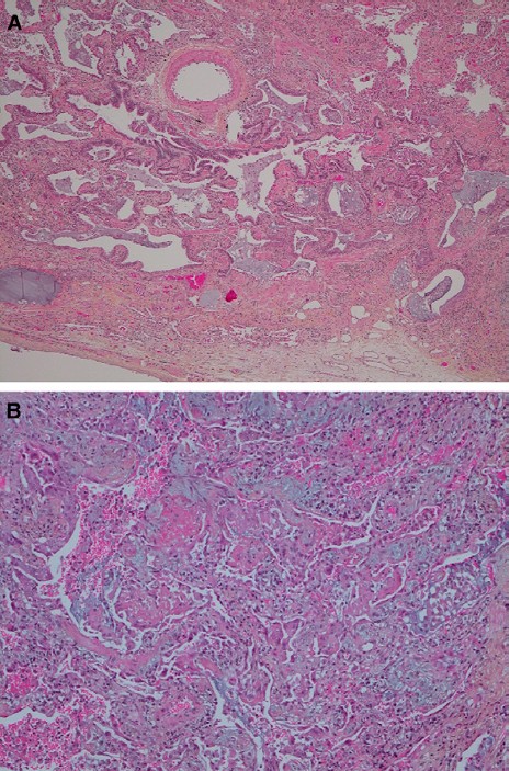 什么是特发性肺纤维病 14295132207891.jpg