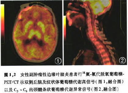 戚晓昆:重视边缘叶脑炎的诊断与鉴别_边缘叶脑