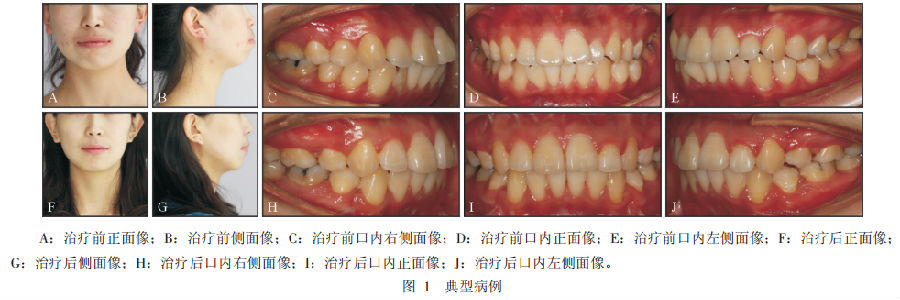 外科与正畸联合治疗骨性Ⅰ类双颌前突1例