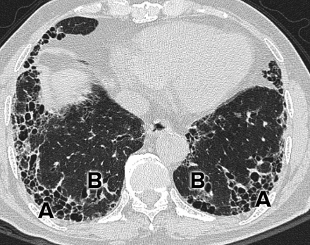 【BMJ】间质性肺病诊治综述之概要篇_间质性肺病_特发性肺纤维化_医脉通