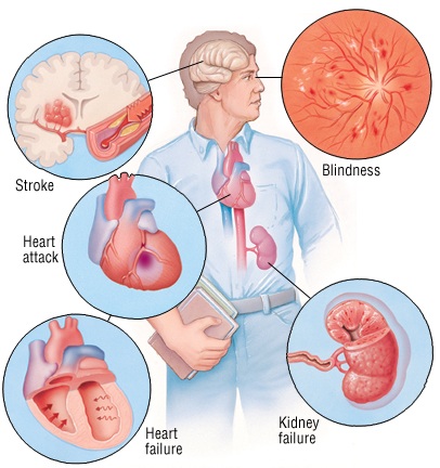 ASH2015]警惕高血压患者的无症状靶器官损害_ASH2015_高血压_无症状靶器官 