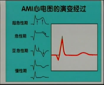 张振刚教授:急性心肌梗死诊断标准的变迁_急性