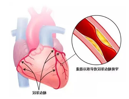 心绞痛药物治疗面面观