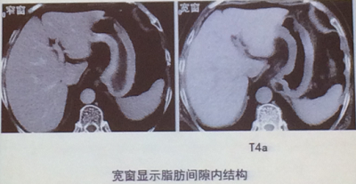 胃癌tnm分期的ct影像分析