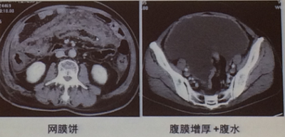 胃癌tnm分期的ct影像分析