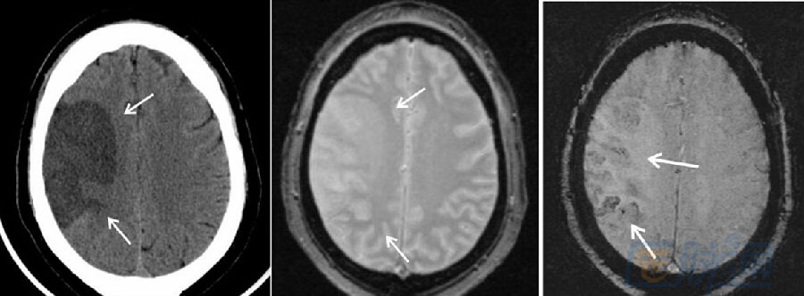 脑出血ct,mri之争的终结者:gre序列t2*&swi
