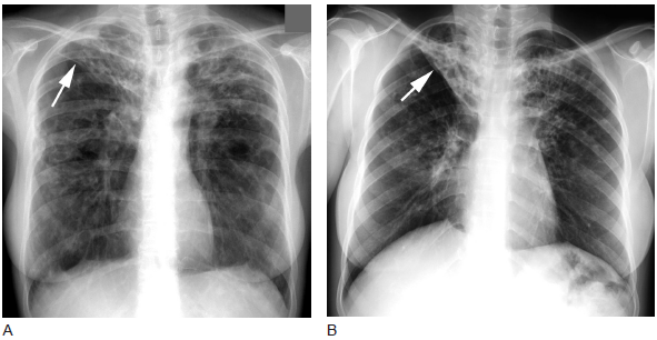 3类支气管扩张相关疾病的影像学(多图)