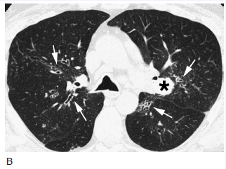 3类支气管扩张相关疾病的影像学(多图)_气管扩