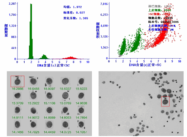 细胞DNA定量分析--中国宫颈癌筛查技术的多元