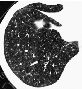 3类细支气管炎的影像学特征(多图)_细支气管炎