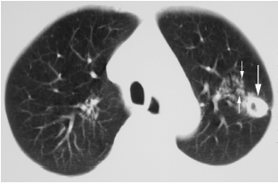 肺结核的影像学表现(多图)_肺结核 _影像学