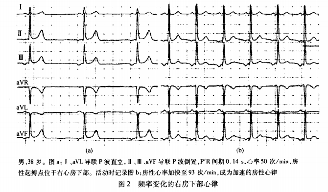 卢喜烈:房性心律解读_房性逸搏_窦性心律_心电图_医脉