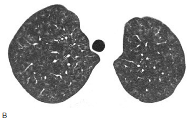 3类肺部病毒感染的影像学鉴别(多图)