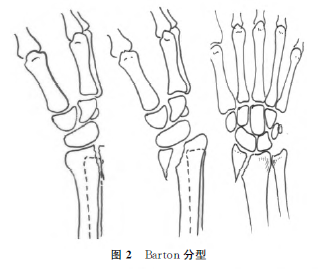 barton骨折_反barton骨折_股骨头坏死x线表现