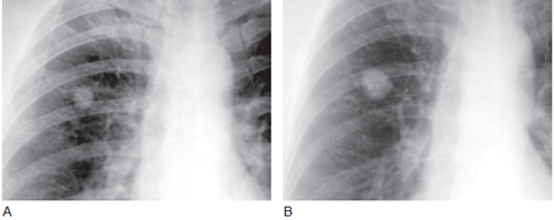 错构瘤影像学详解(多图)