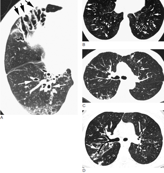 例支气管扩张患者的ct 表现