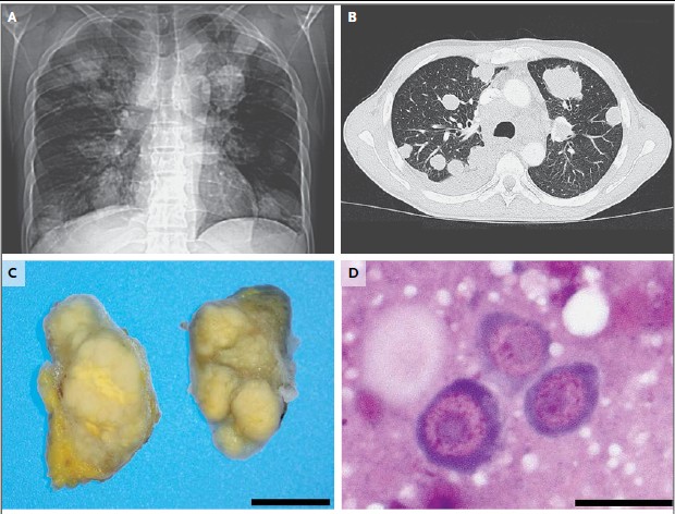 NEJM：绦虫感染竟成癌？