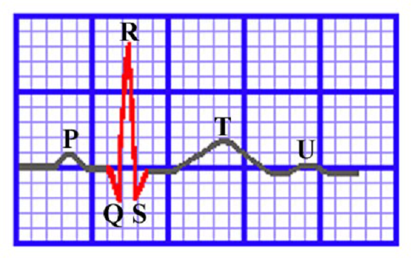 心电图qrs波群的五种变态行为