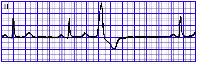 在心电图上表现就是在经历一个较长的间歇后,心室发出一个电冲动
