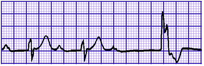 心电图qrs波群的五种"变态"行为