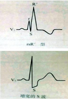 心电图qrs波群的五种"变态"行为