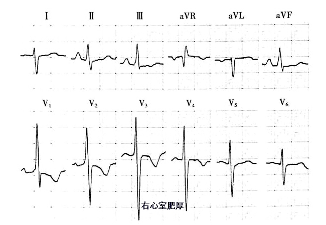 心电图QRS波群的五种变态行为_心电图_QR