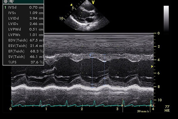 lv测量值的超声心动图像(胸骨旁长轴观)