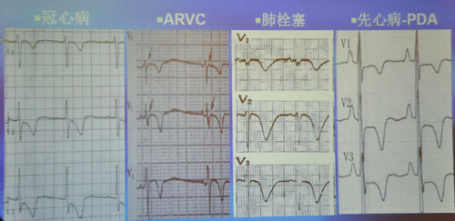 临床必备:2小时学看心肌缺血心电图