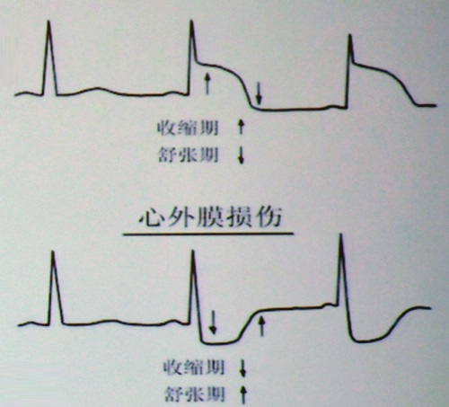 [CMIT2015]临床必备:2小时学看心肌缺血心电图(四)_动态心电图_心肌缺血_CMIT2015_医脉通