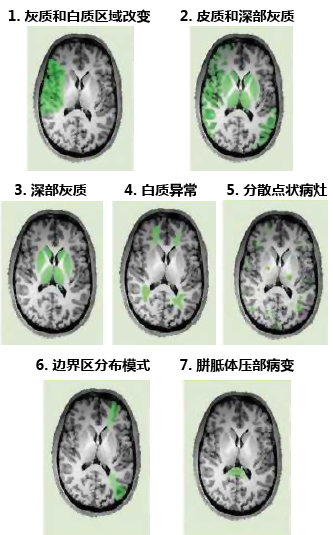 脑卒中影像学鉴别诊断(一:灰质白质改变
