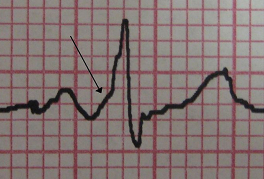预激综合征:边看图，边答题，边学习(上)_预激综合征_医脉通