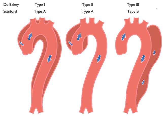 二,主动脉夹层分型 目前临床多使用斯坦福ad分型:无论受累范围,只要