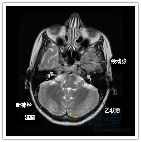 简明易懂的脑部断层解剖:横断位mri