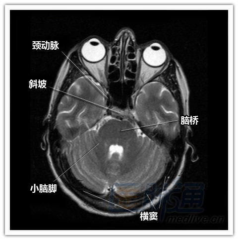 结构 图 乐高 英雄 工厂 大脑 入侵 大脑 结构 图 见 ...