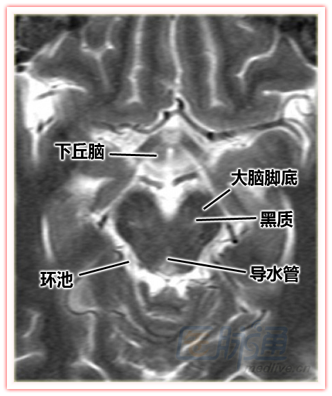 简洁清晰的脑部特定区域断层解剖图谱