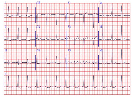 图文并茂|当预激遇上房颤_预激综合征_WPW综合征_房颤_医脉通